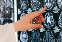 Científicos Identifican una Nueva Enfermedad Neurológica Ultrarrara con Solo 13 Casos en el Mundo